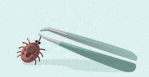 ¿La Enfermedad de Lyme se transmite por vía sexual? 4 Ilustración de unas pinzas retirando una garrapata de forma segura